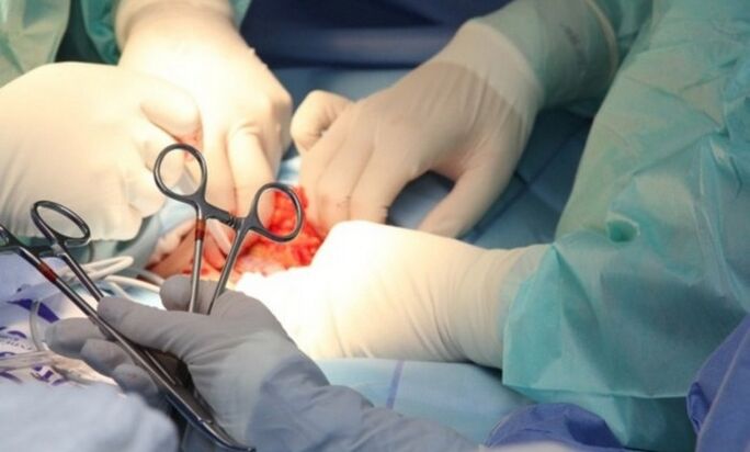 Legamentotomia – intervento chirurgico per ingrandire il pene