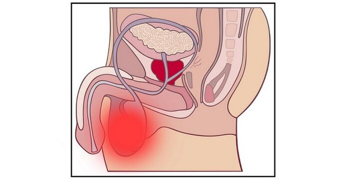 Una complicazione dell’intervento di ingrandimento del pene può essere l’infiammazione dei testicoli. 