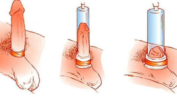Il principio di funzionamento di una pompa a vuoto che può ingrandire il pene
